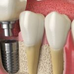 Implants, The Optimal Solution for Missing Teeth