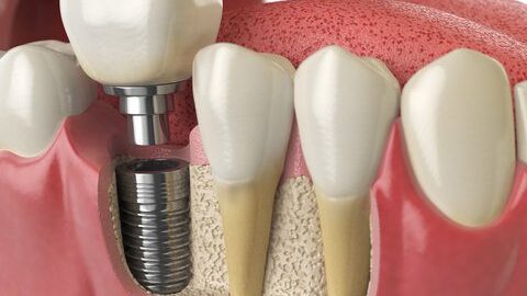 Implants, The Optimal Solution for Missing Teeth