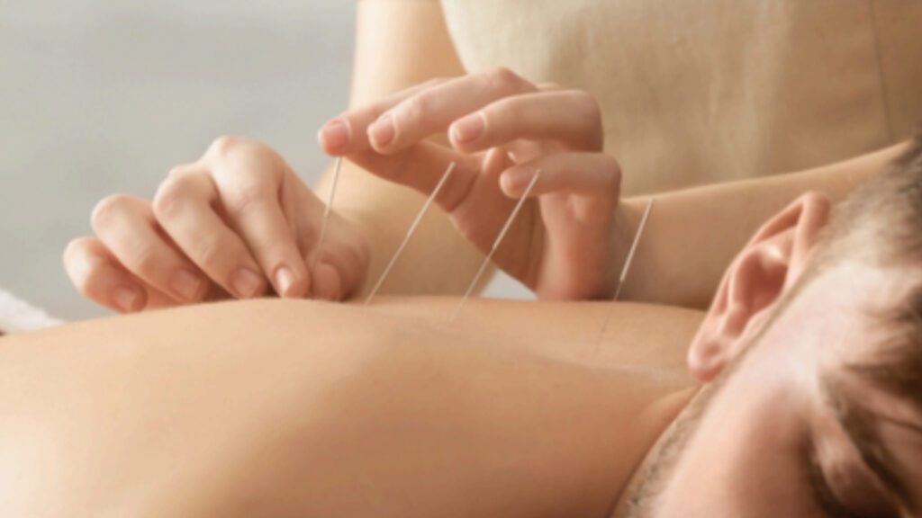 Finding Relief Naturally: Acupuncture’s Impact on Chronic Headaches and Migraines