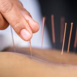 Ancient Practice, Modern Healing: Why More Patients Are Turning to Acupuncture