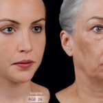 Timeline of Facial Aging