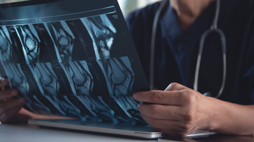 Stronger Bones, Smarter Screening