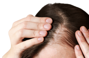 Female Pattern Baldness-The Shop on 7 DBA Head Space-Loudonville Neighbors