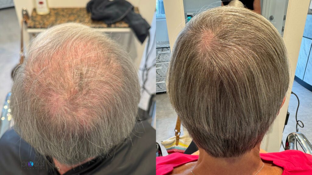 Hair Follicle Rejuvenation – A New Frontier
