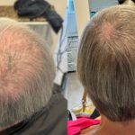 Hair Follicle Rejuvenation – A New Frontier