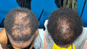 Hair loss before after-Acupuncture health NJ-Little Silver Neighbors