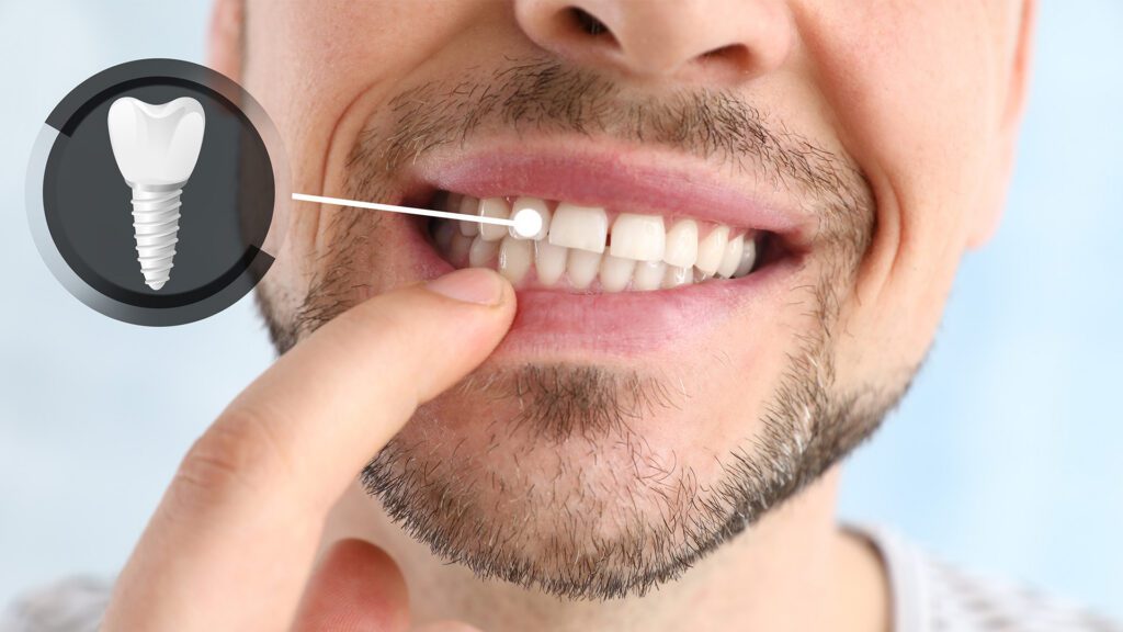 Why Dental Implants Fail — and How We Can Prevent It
