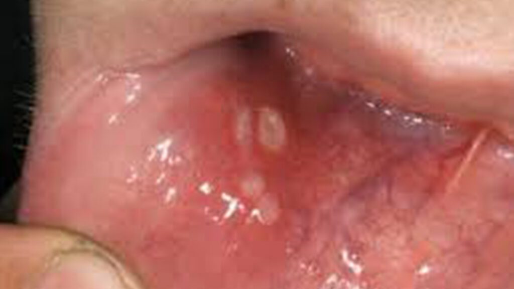 Lumps and Bumps in the Mouth