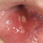 Lumps and Bumps in the Mouth