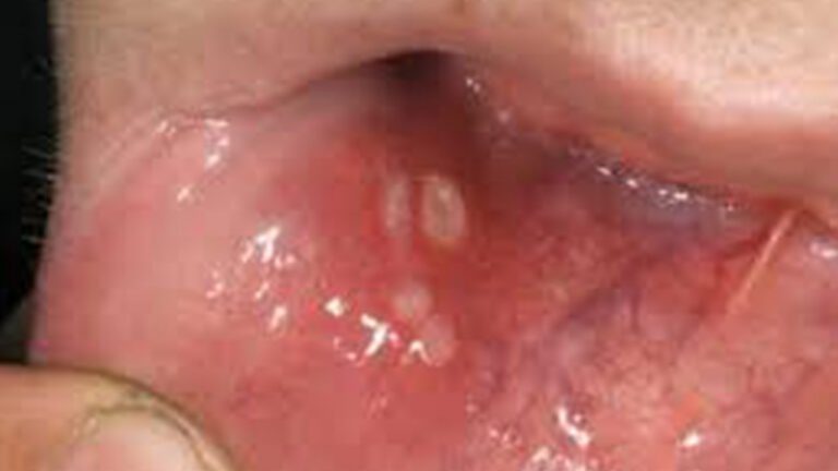 Lumps and Bumps in the Mouth