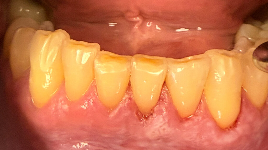 How Non-Surgical Emdogain Is Changing Modern Dentistry Through Prevention, Preservation, and Regeneration