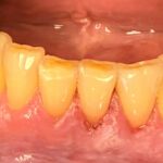 How Non-Surgical Emdogain Is Changing Modern Dentistry Through Prevention, Preservation, and Regeneration