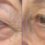 A Lift for Tired Eyes: A Non-Invasive Treatment for Under-Eye Bags and Dry Eye