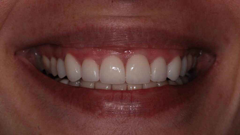 Smiling From Ear to Ear at Spring Lake Dental