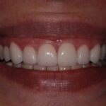 Smiling From Ear to Ear at Spring Lake Dental