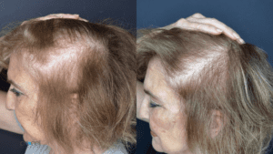 Woman Hair loss before after-Acupuncture health NJ-Little Silver Neighbors