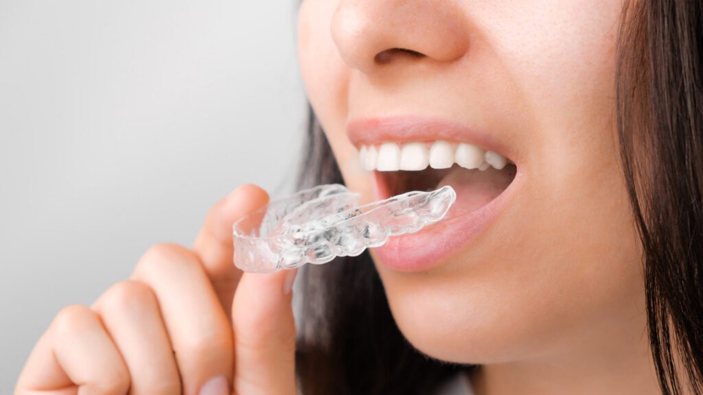 How Are Removable Clear Aligners Used in Orthodontics?