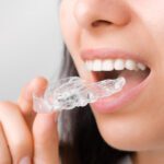 How Are Removable Clear Aligners Used in Orthodontics?