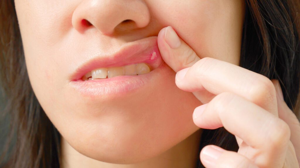 Evaluating Lumps and Bumps in the Mouth