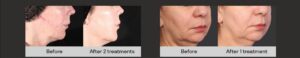 XERF Results Sore Wellness