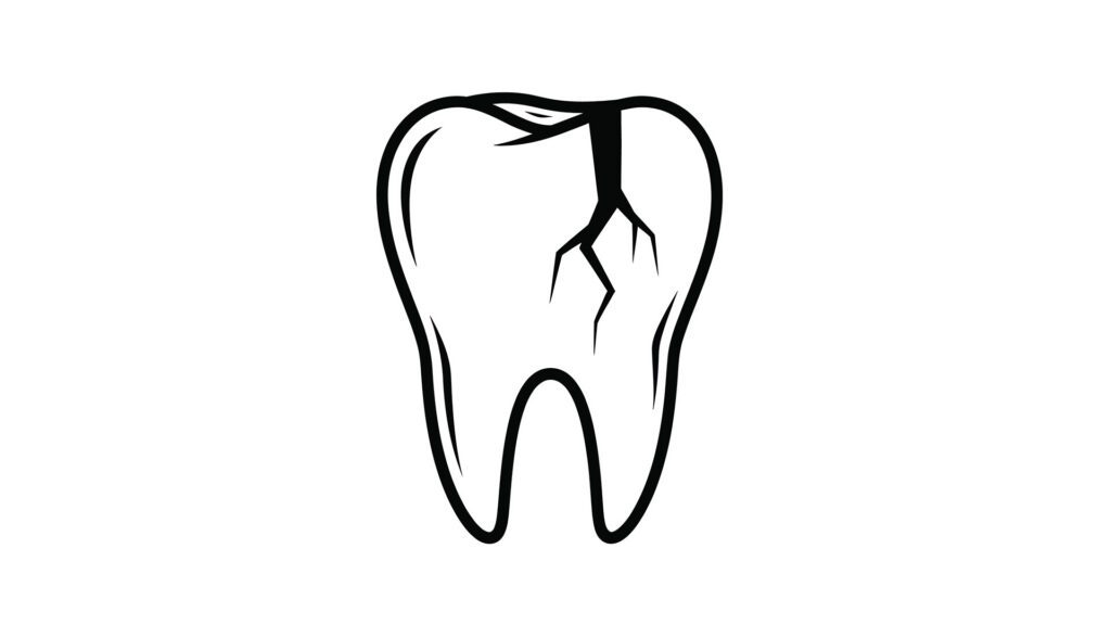 Cracked Teeth: What Clarkston Residents Should Know to Protect Their Smiles