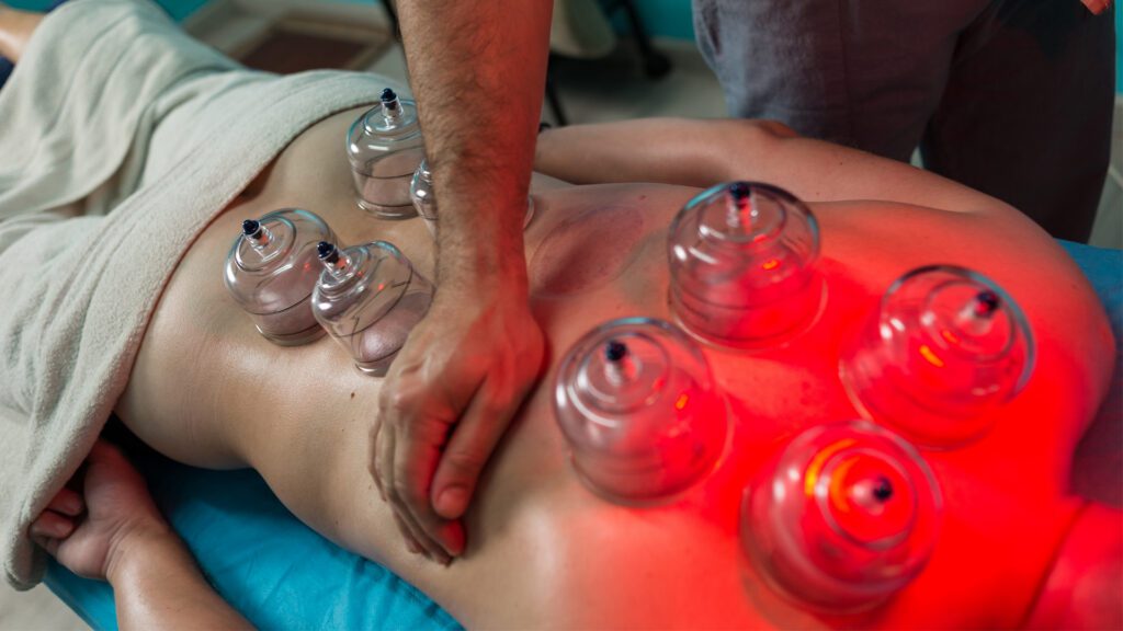 Cupping Isn’t Just for Olympians