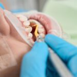 What is a Deep-Cleaning?