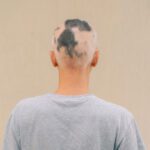 Alopecia Areata: Why Am I Losing Hair in Patches?