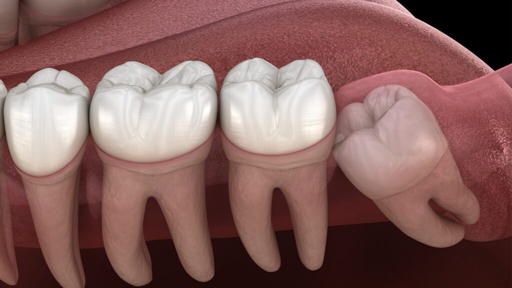 When Do Wisdom Teeth Become a Concern?