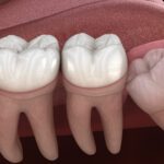 When Do Wisdom Teeth Become a Concern?