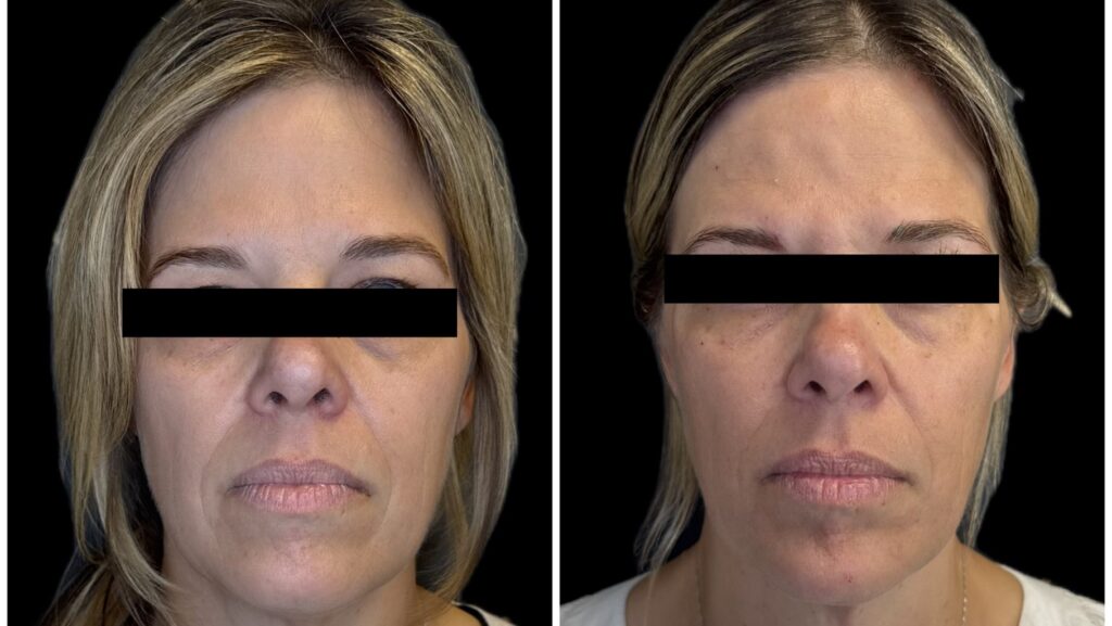 Maintaining Facial Balance and Preventing ‘Ozempic Face’
