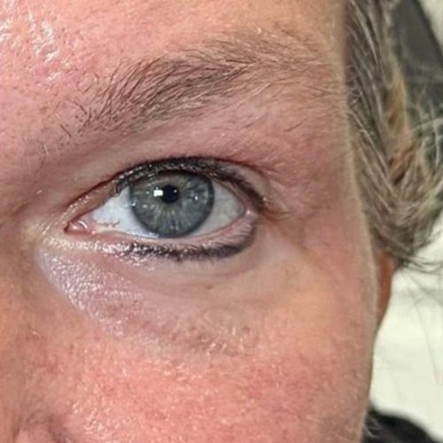 After Aerolase Laser The Rural Aesthetic Med Spa