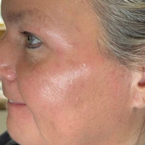 After skin treatment The Rural Aesthetic Med Spa