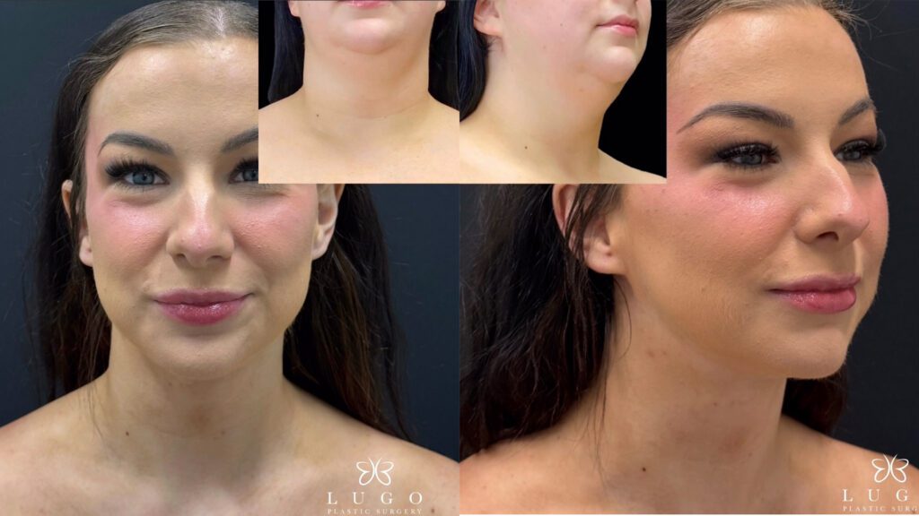 Beyond Liposuction