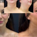 Beyond Liposuction