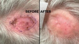 Before and After Melanoma Florida Skin Cancer Institute