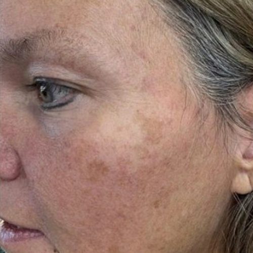 Before skin treatment The Rural Aesthetic Med Spa