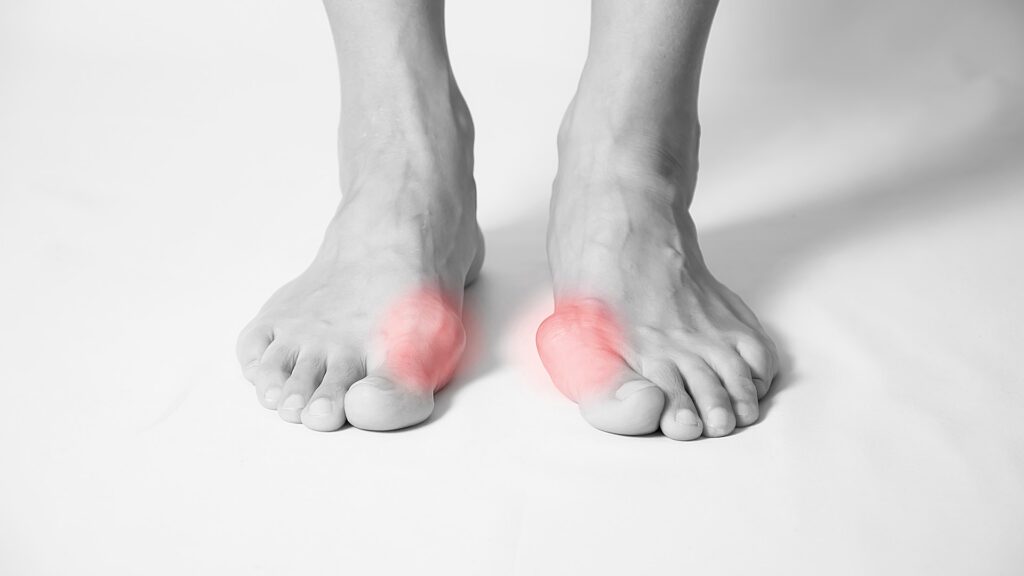 Bunion Deformities: What They Are and How They’re Treated