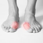 Bunion Deformities: What They Are and How They’re Treated