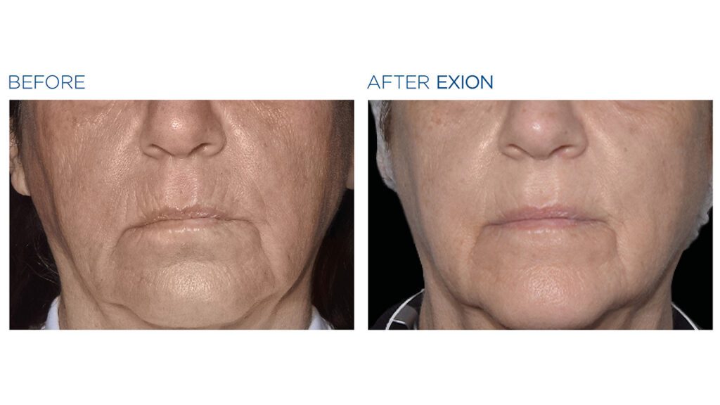 Exion before and after skin photo Hinkle Group LLC