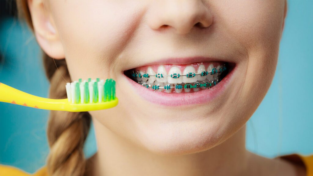 Summer Braces Tips for Orthodontic Patients
