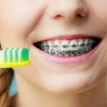 Summer Braces Tips for Orthodontic Patients