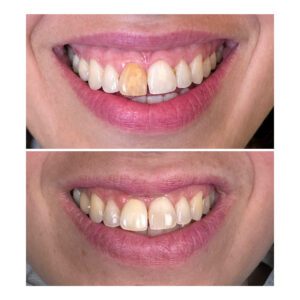 Internal tooth bleaching-Schulman Dental Studio Franklin Lakes