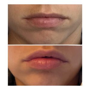 Lip flip-Schulman Dental Studio Franklin Lakes