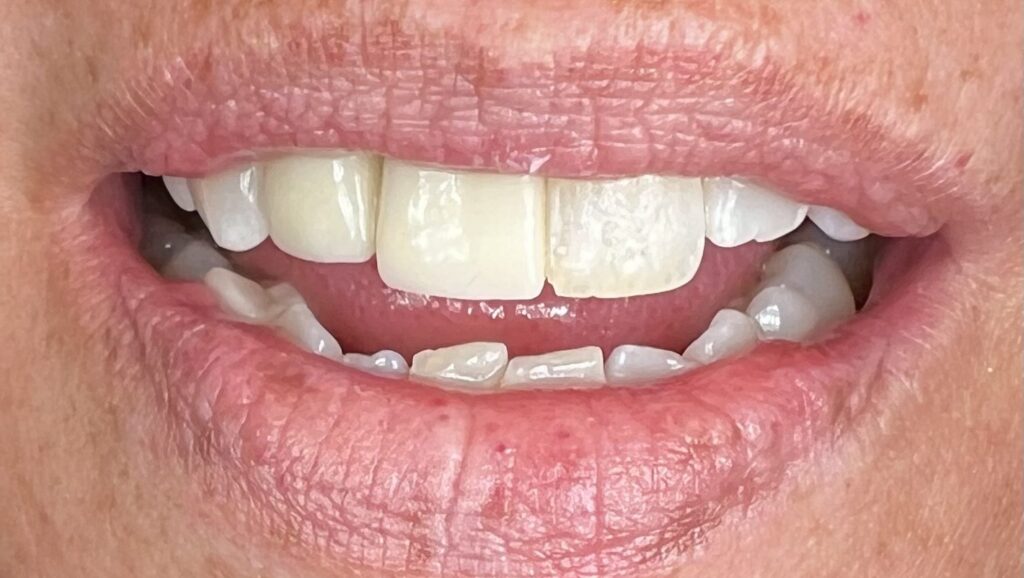 Dental Implants: Restoring Function, Esthetics and Quality of Life