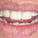 Dental Implants: Restoring Function, Esthetics and Quality of Life