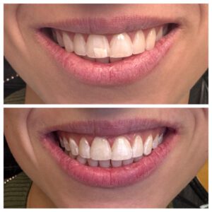 Resin infiltrate-Schulman Dental Studio Franklin Lakes