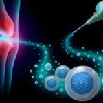 Stem Cell Therapy for Joint Injections: Expert Insights From Dr. Derek Morrison