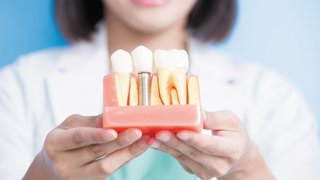 The Truth About Dental Implants: What We Wish Every Patient Knew