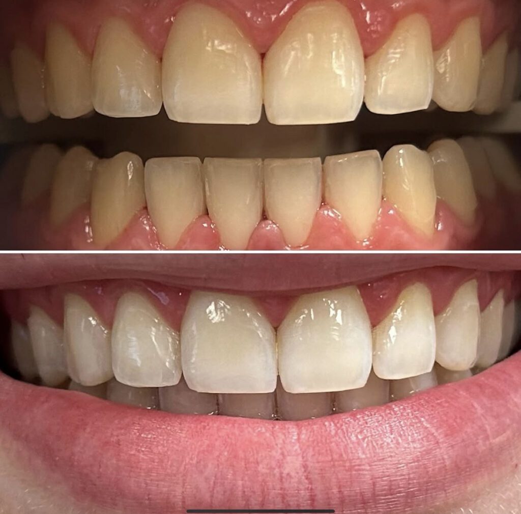 Five Non-Invasive Treatments That Can Transform Your Smile